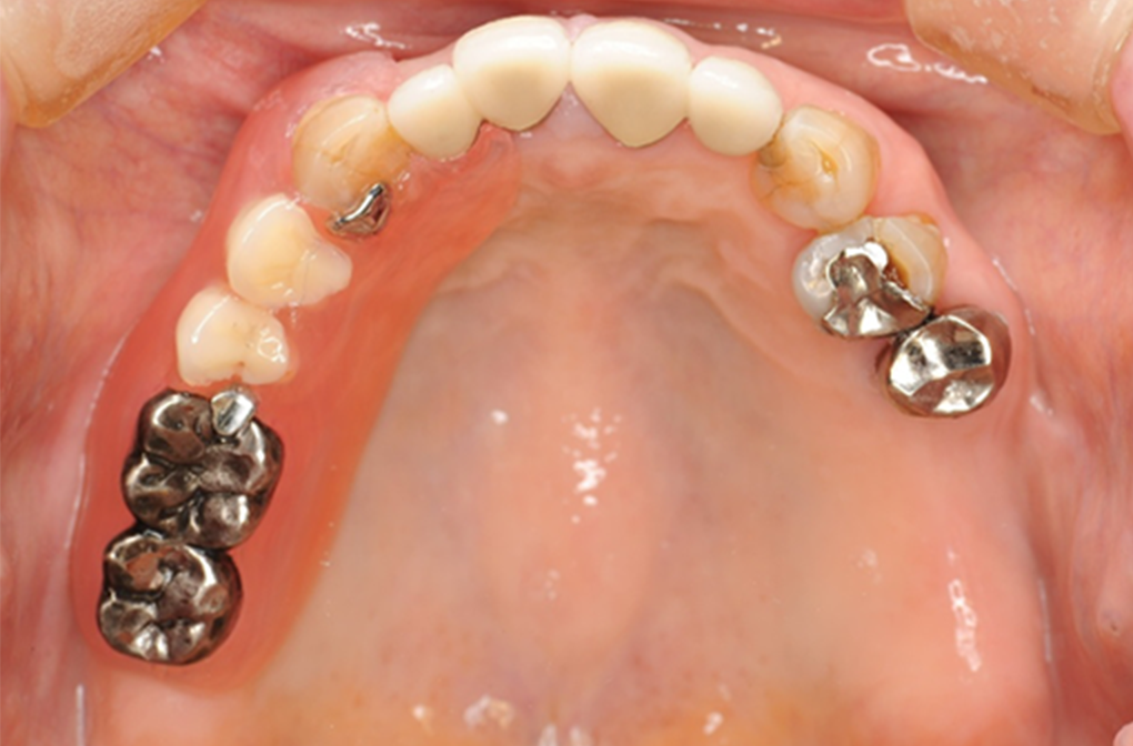 入れ歯（義歯）治療 症例1 after
