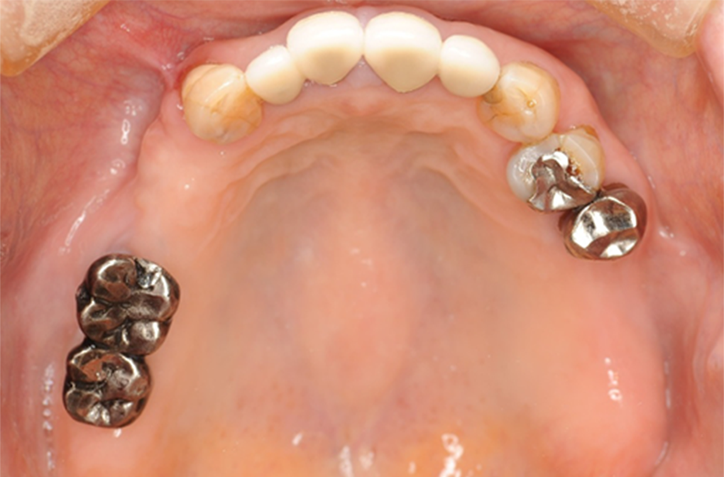 入れ歯（義歯）治療 症例1 before