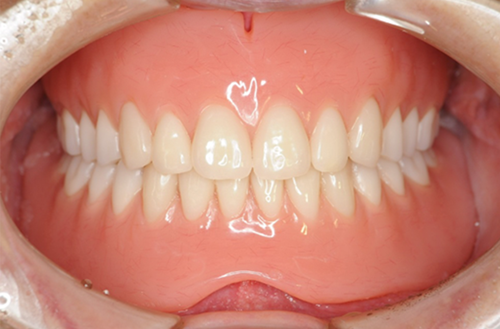 入れ歯（義歯）治療 症例2 after