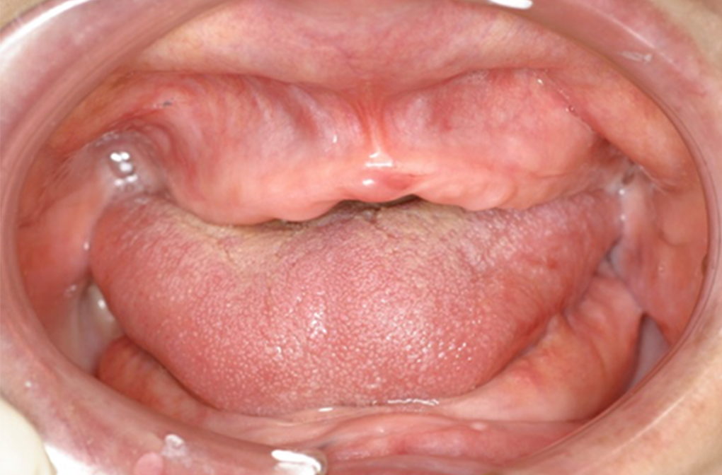 入れ歯（義歯）治療 症例2 before