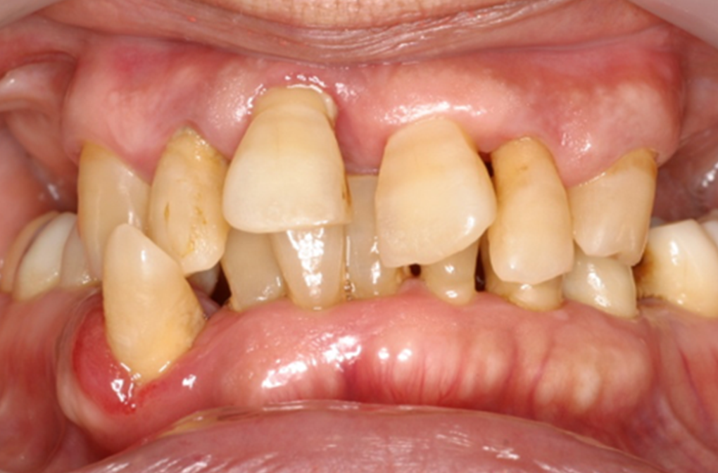審美的歯科治療 症例1 before