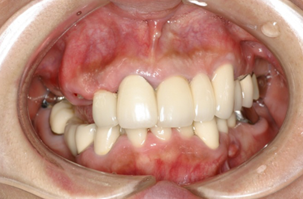審美的歯科治療 症例3 before