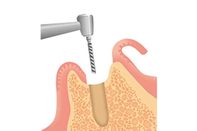 インプラント一次手術