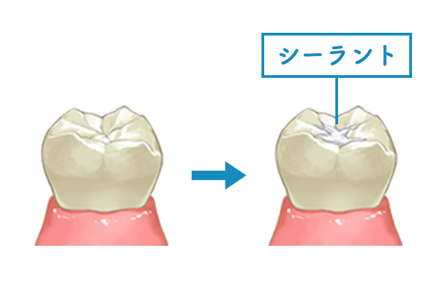 シーラント